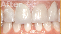 Beverly Hills Dental Crowns