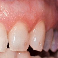Beverly Hills Tooth Fillings