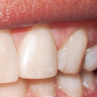 Beverly Hills Tooth Fillings